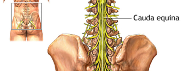 Síndrome da cauda equina-Diagnóstico e sintomas.