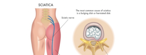 tratamento dor ciatica