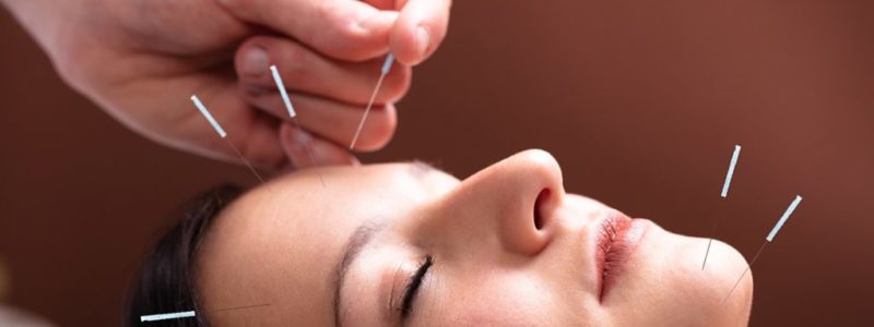acupuntura e migraina