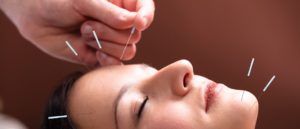 acupuntura e migraina