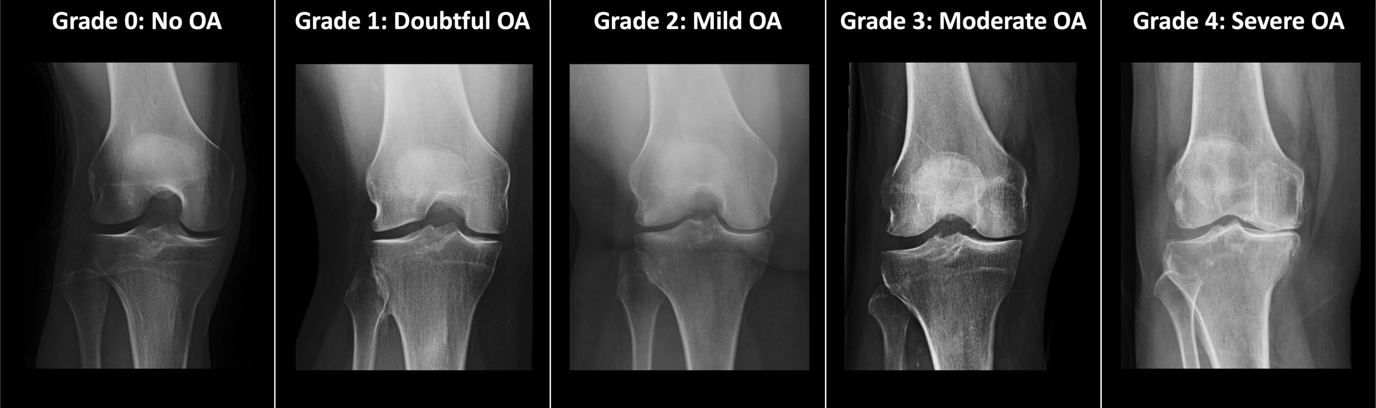 tratamento na osteoartrite de joelho