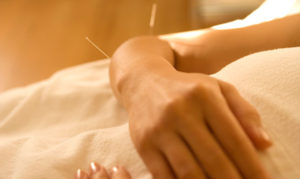 acupuntura na gestação é seguro?
